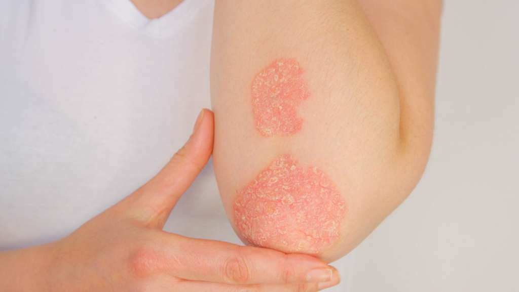 apa itu psoriasis