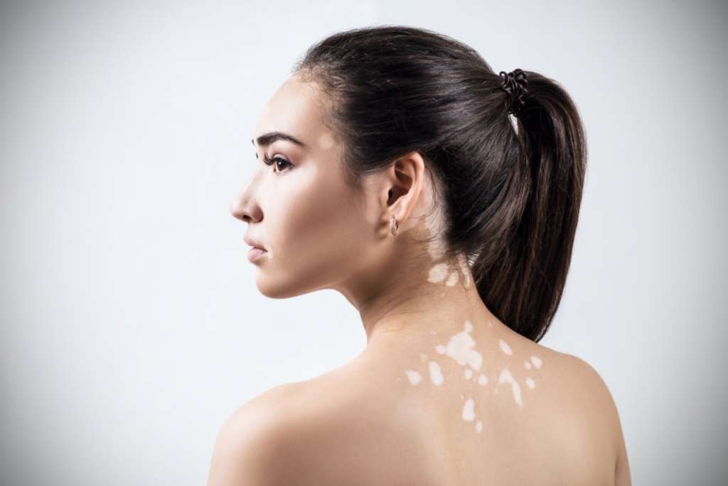 apa itu vitiligo