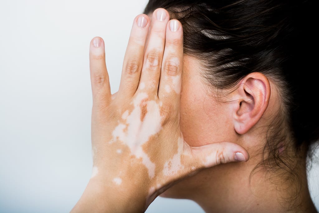 Pengobatan Vitiligo