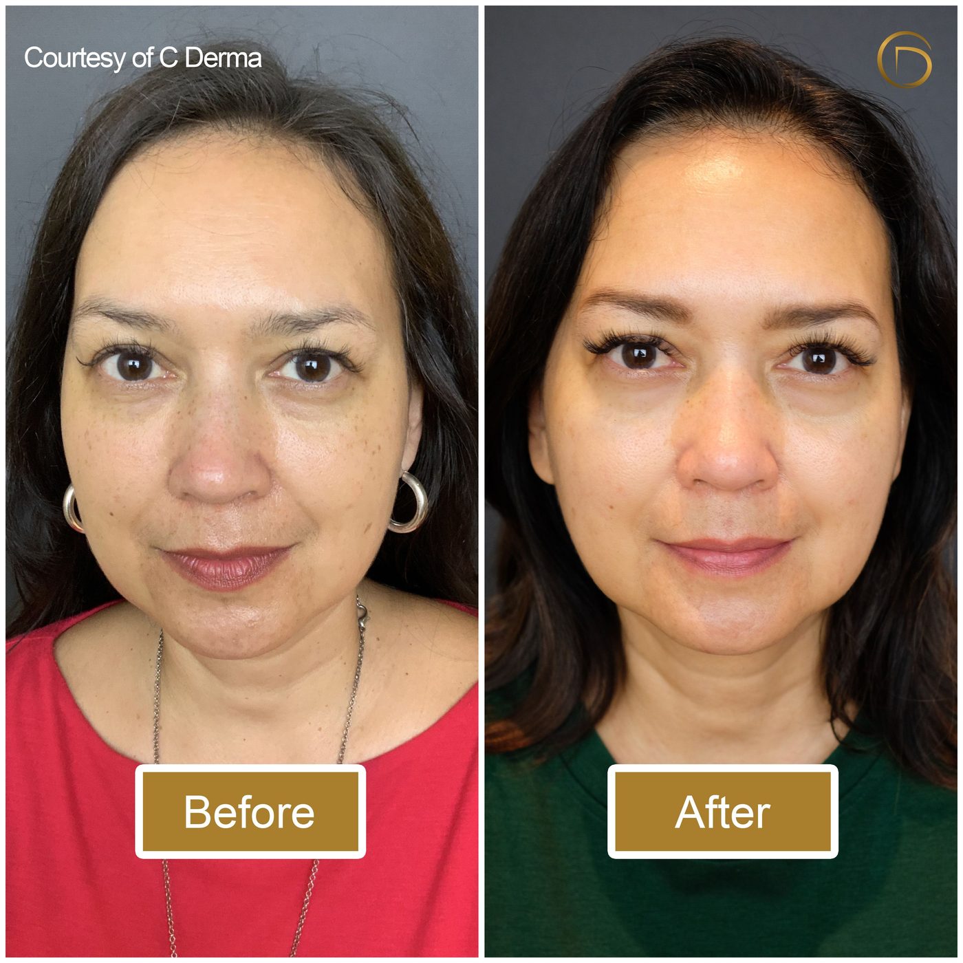 Hasil sebelum dan sesudah perawatan Ultherapy di C Derma