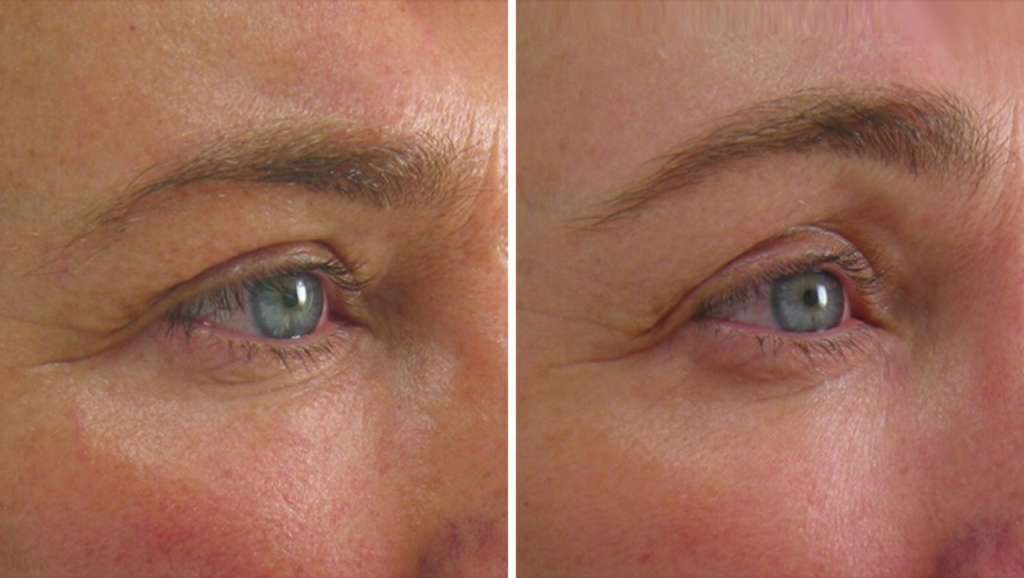 Perawatan ULTHERAPY
