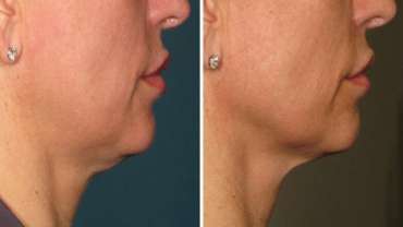 Perawatan ULTHERAPY®, Awet Muda Tanpa Operasi