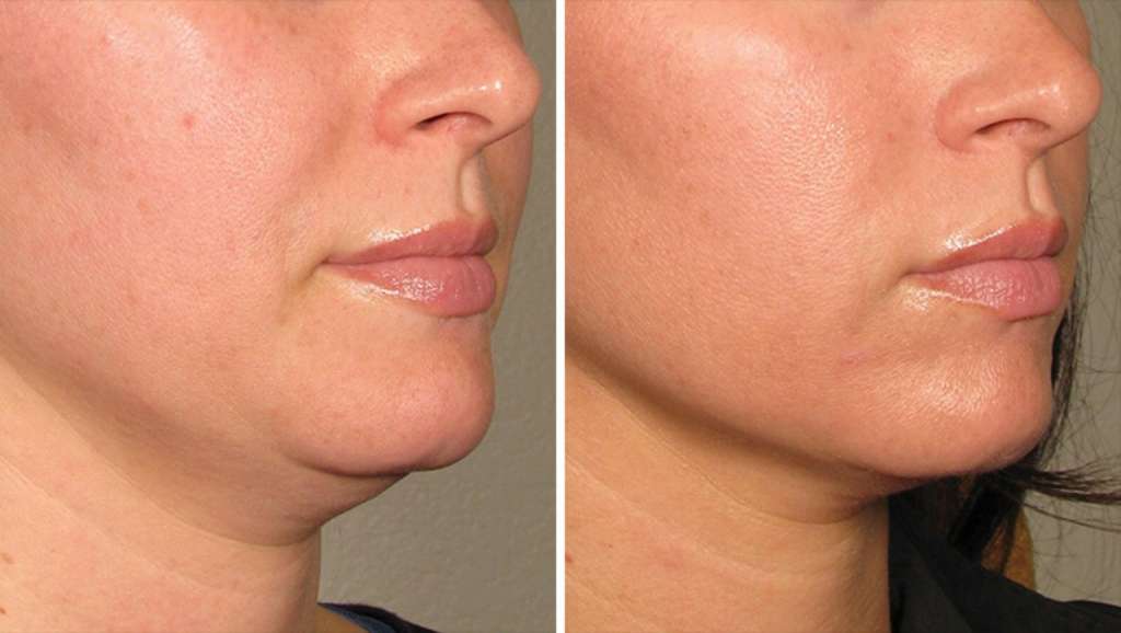 Perawatan ULTHERAPY