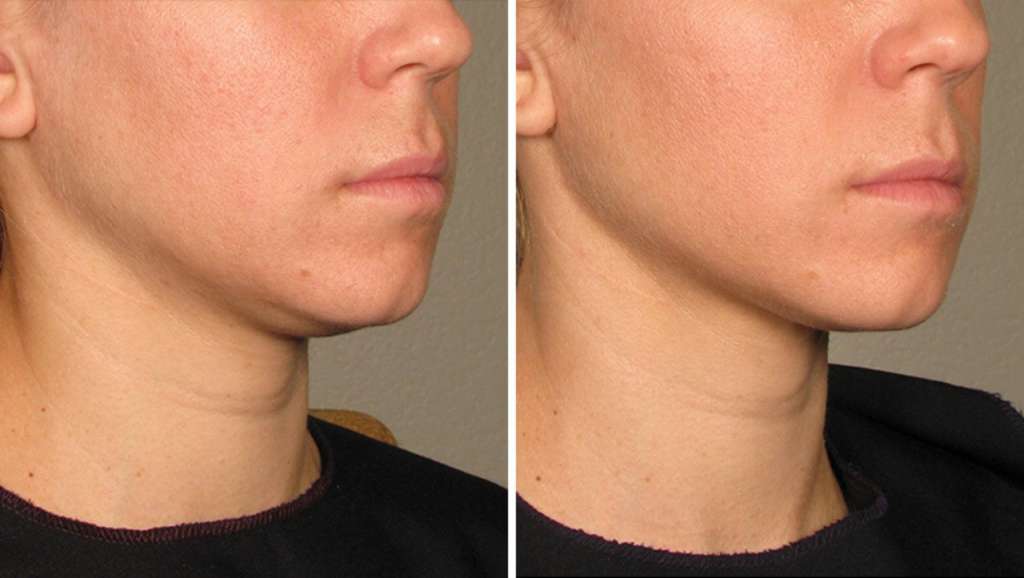 Perawatan ULTHERAPY