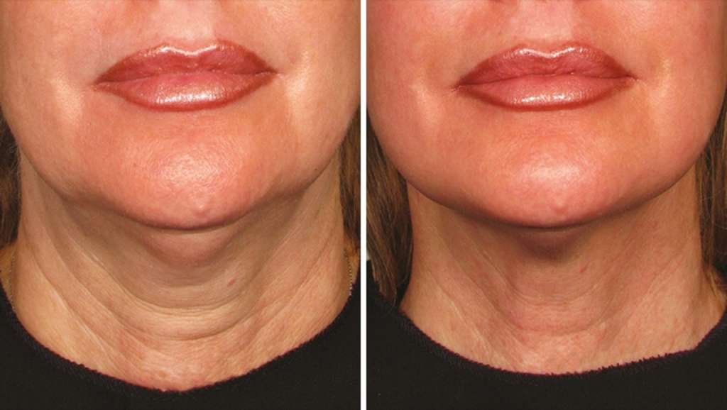 Perawatan ULTHERAPY