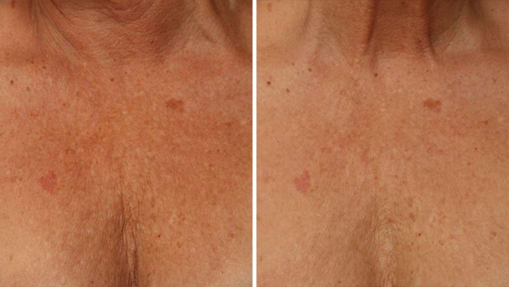 Perawatan ULTHERAPY