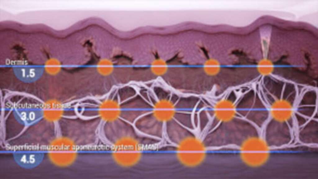 Perawatan ULTHERAPY