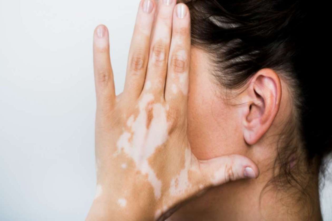 apa itu vitiligo