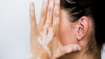 Apa Itu Vitiligo? Gejala, Penyebab dan Pengobatannya