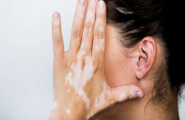 pengobatan vitiligo