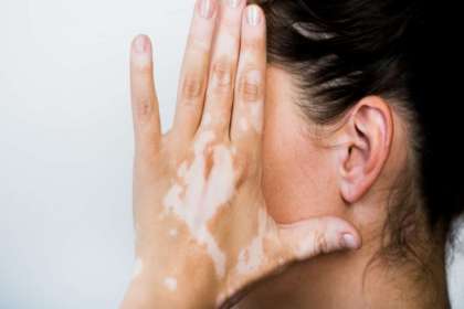 apa-itu-vitiligo apa itu vitiligo