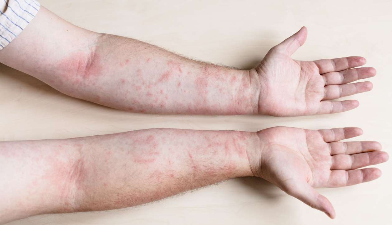 dermatitis kontak