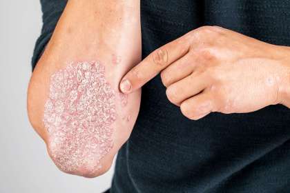 Jenis Psoriasis