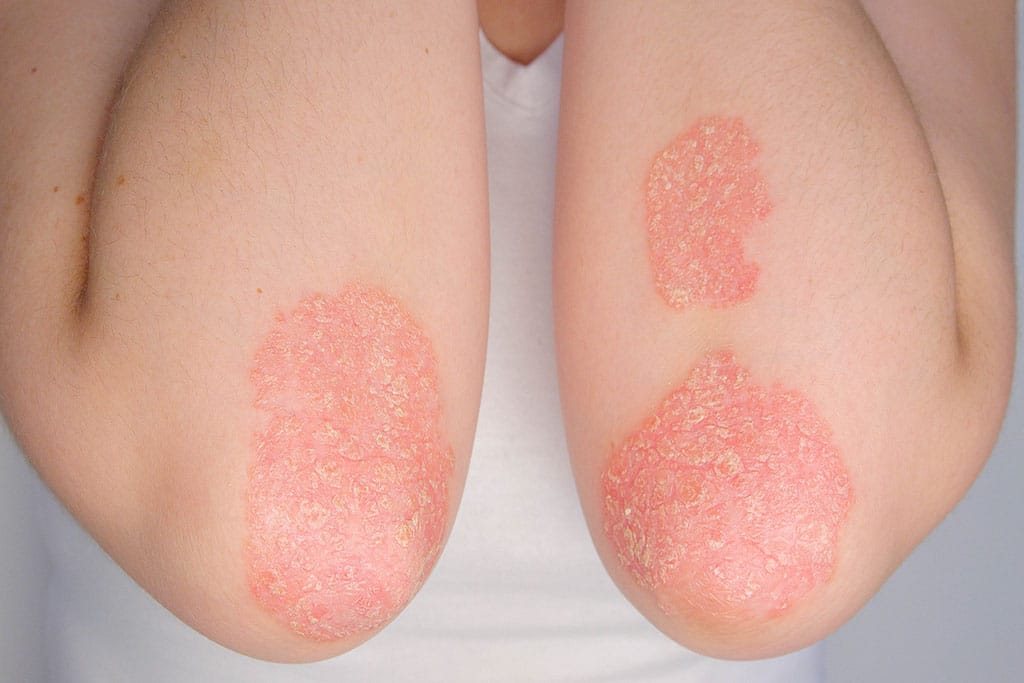 Psoriasis Adalah Waspadai Penyakit Kulit Kronis Ditandai Ruam Kulit