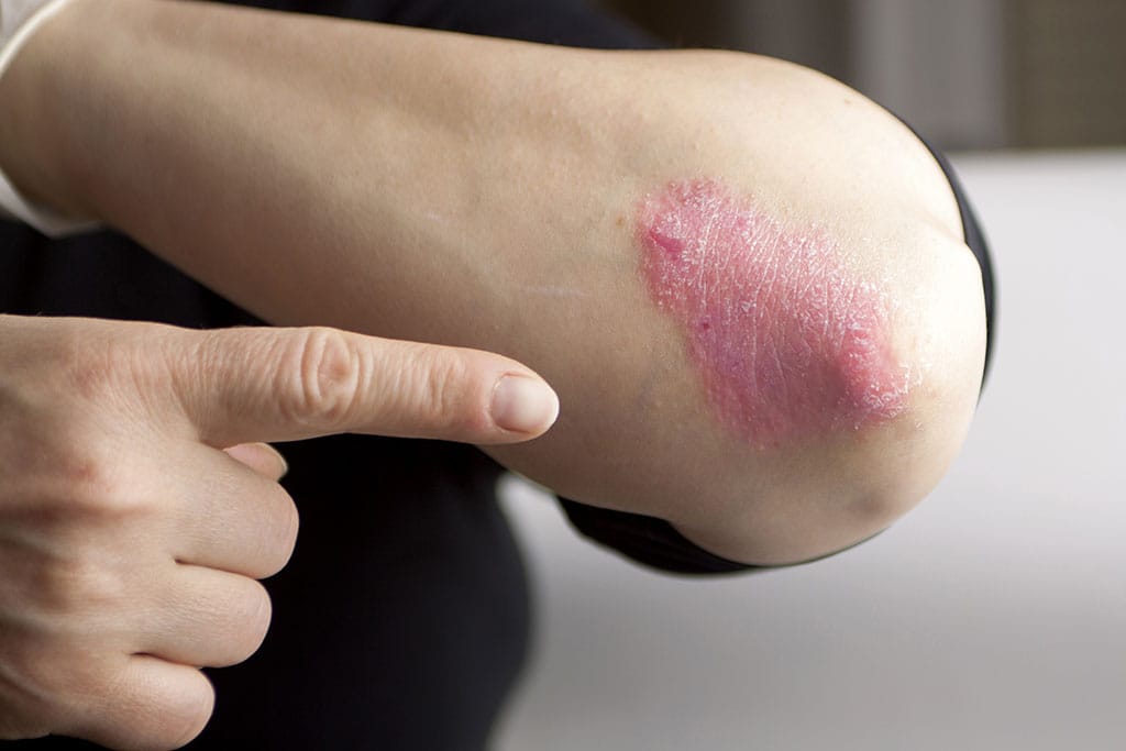Penyakit Psoriasis