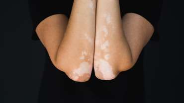 Pengobatan Vitiligo dengan Laser 311nm Saphire Laser (Pallas®)