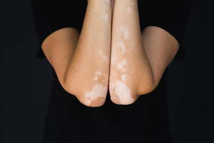 Vitiligo,On,Hands,And,Elbows,With,Black,Background Pengobatan Vitiligo dengan Laser 311nm Saphire Laser (Pallas®)
