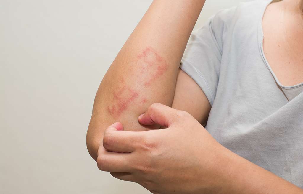 Meglepő pikkelysömör (psoriasis) tünet enyhülések Gomba kezelése pikkelysömörhöz