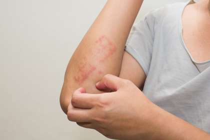 perbedaan dermatitis seboroik dan psoriasis
