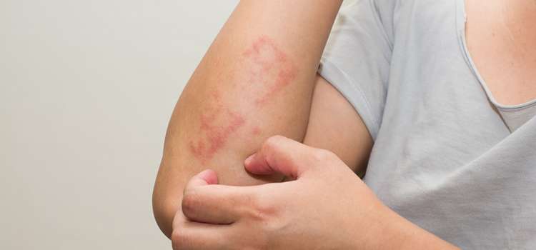 Perbedaan Dermatitis Seboroik dan Psoriasis!