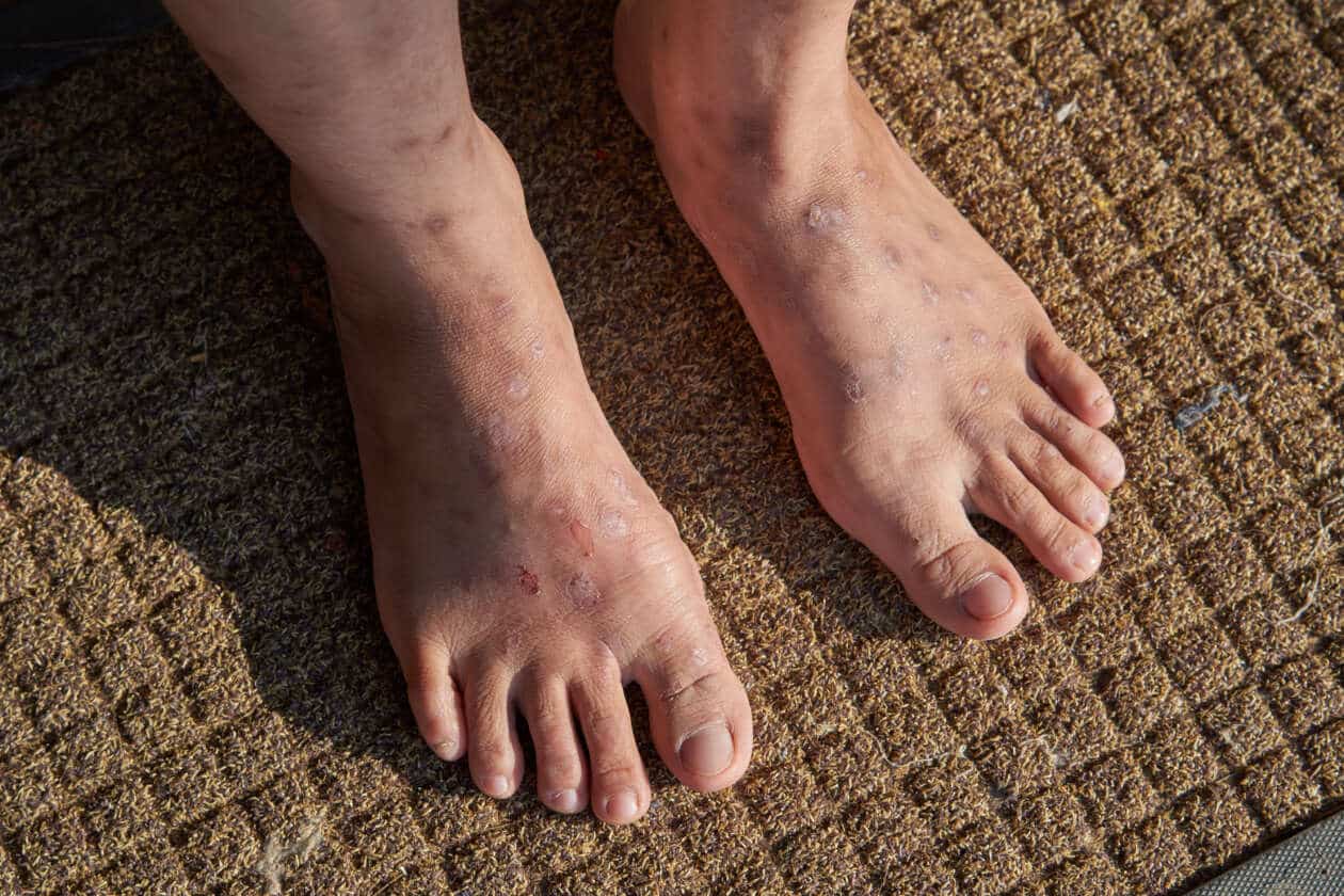 cara mengobati eksim di kaki