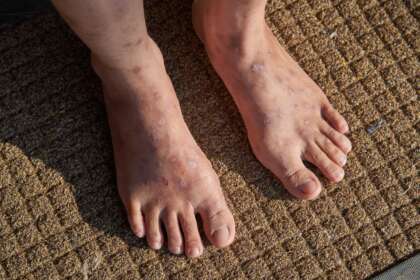 cara mengobati eksim di kaki