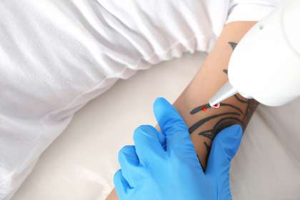 Woman,Undergoing,Laser,Tattoo,Removal,Procedure,In,Salon,,Closeup Cara Menghapus Tato Permanen