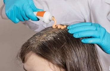 psoriasis kulit kepala