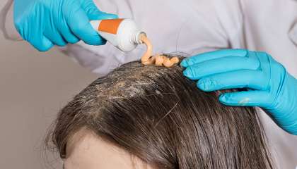 psoriasis kulit kepala