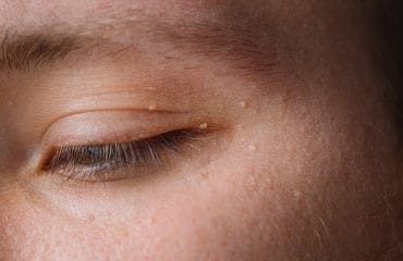 cara menghilangkan bintik putih di wajah