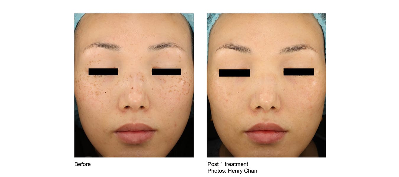 picoway before after 3