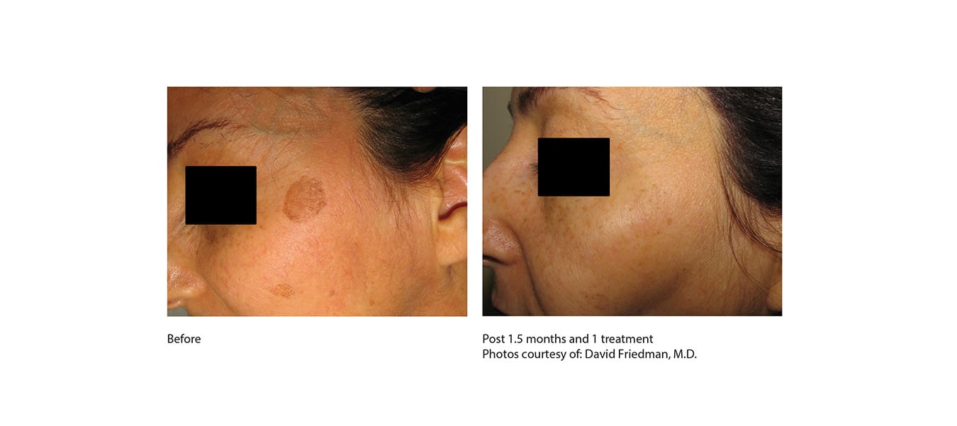 picoway before after 4