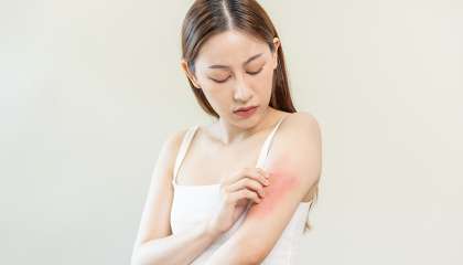 dermatitis kontak alergi
