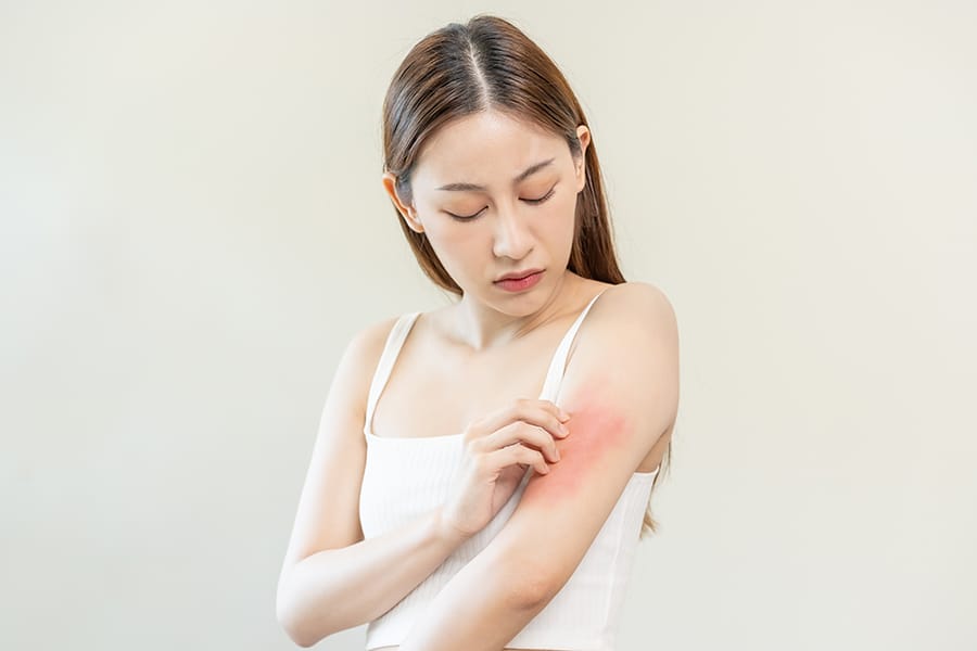 Serba-Serbi Dermatitis kontak Alergi