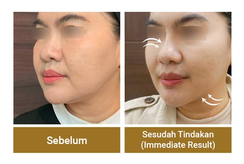 Thread Lift / tanam benang membuat wajah terlihat kencang