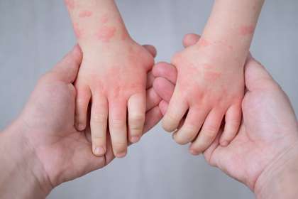 Close,Up,Mother,Holding,Kids,Hands,With,Allergic,Rash,Or