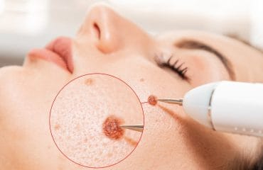 prosedur operasi tahi lalat