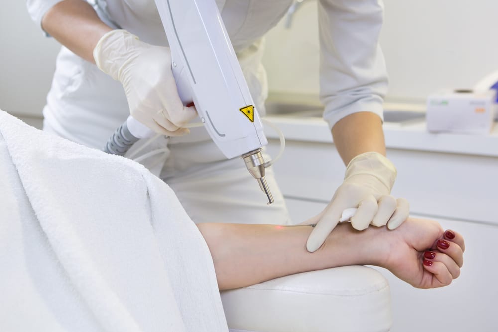 cara mengatasi Keratosis Seboroik
