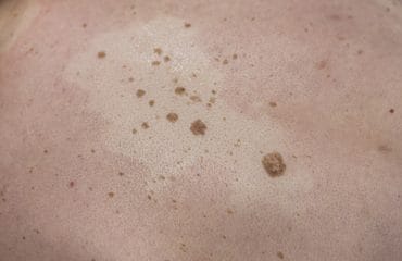 Keratosis Seboroik