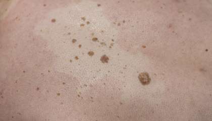 Keratosis Seboroik