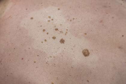 Keratosis Seboroik