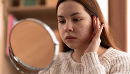 Kenali Sel Kulit Mati di Wajah, Penyebab hingga Cara Mengatasinya