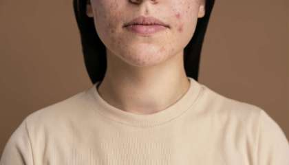 ciri-ciri skin barrier rusak