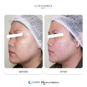 before after Ultraformer MPT