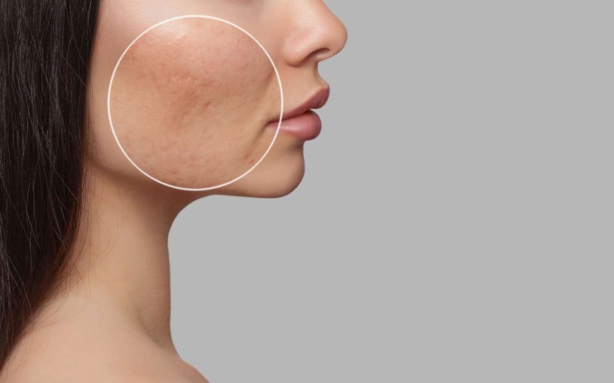 10 Cara Cepat Menghilangkan Bopeng (Scars) dengan Tindakan Medis