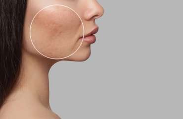 10 Cara Cepat Menghilangkan Bopeng (Scars) dengan Tindakan Medis