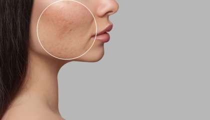 10 Cara Cepat Menghilangkan Bopeng (Scars) dengan Tindakan Medis