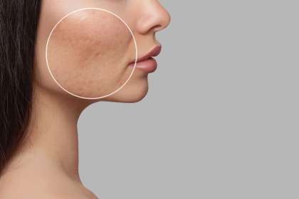 10 Cara Cepat Menghilangkan Bopeng (Scars) dengan Tindakan Medis