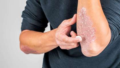 Pengobatan Psoriasis
