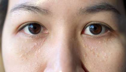 Milia adalah bintik putih pada kulit